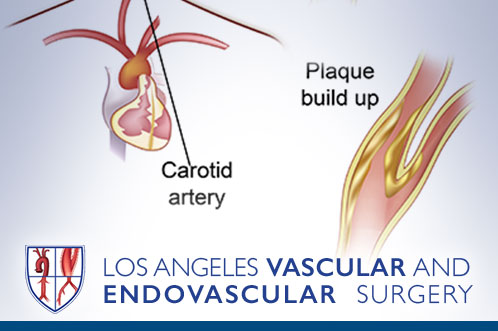 Carotid Artery Disease, Stroke, Transient Ischemic Attacks
