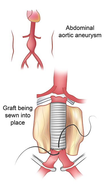 Abdominal Aortic Aneurysm