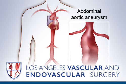 Abdominal Aortic Aneurysm