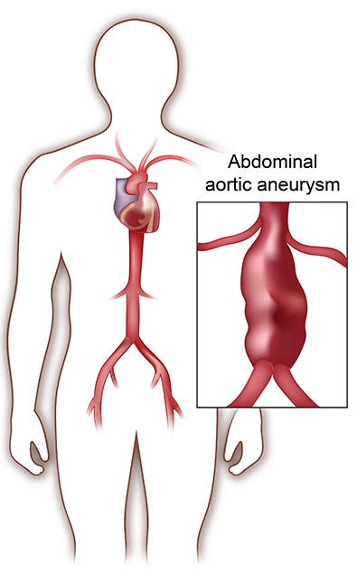 Abdominal Aortic Aneurysm