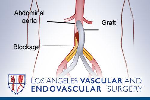 Aortoiliac Occlusive Disease