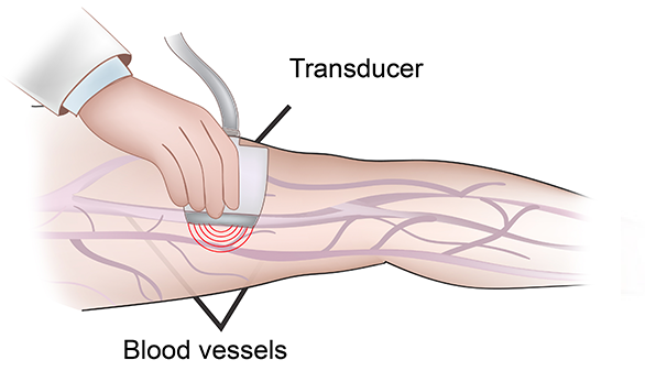 Endovascular stent graft