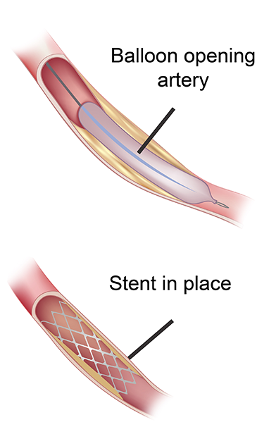 Endovascular stent graft