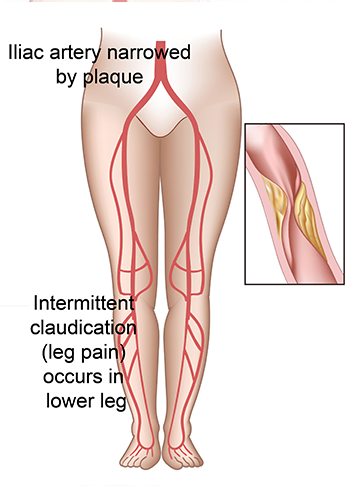 Aortoiliac Occlusive Disease