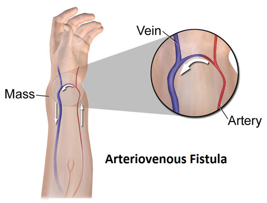 Arteriovenous Fistula Arteriovenous Fistula