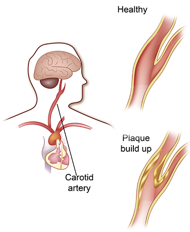 Endovascular stent graft