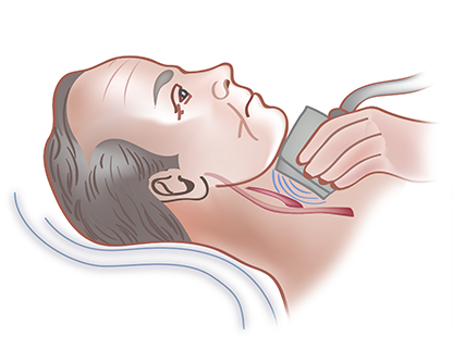 Endovascular stent graft