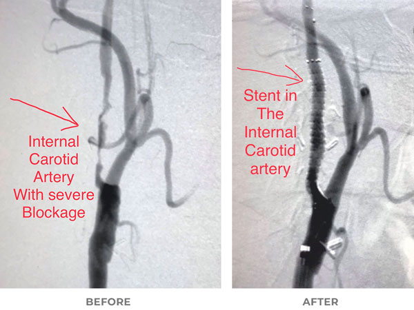 Endovascular stent graft