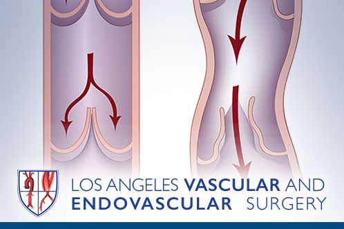 Chronic Vein Disease (Varicose Veins)