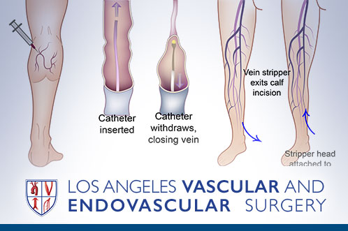 Chronic Venous Insufficiency