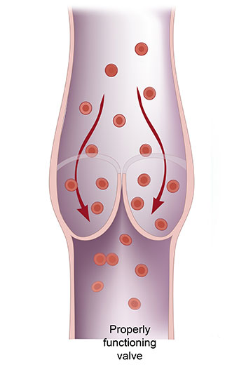 DEEP VEIN THROMBOSIS