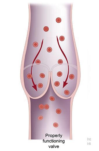 Chronic Venous Insufficiency