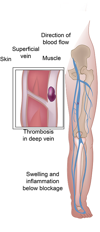 Chronic Venous Insufficiency