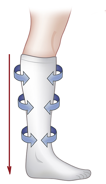 Chronic Venous Insufficiency