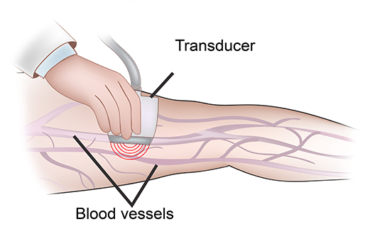 DEEP VEIN THROMBOSIS