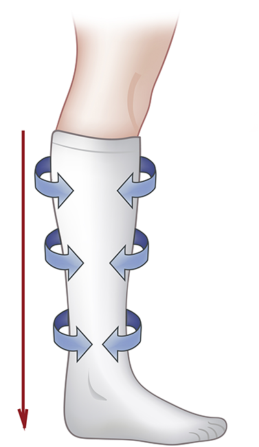 DEEP VEIN THROMBOSIS