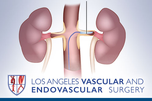 End stage renal disease <br>and Dialysis access