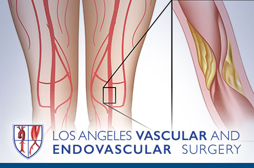 Peripheral Artery Disease (PAD)