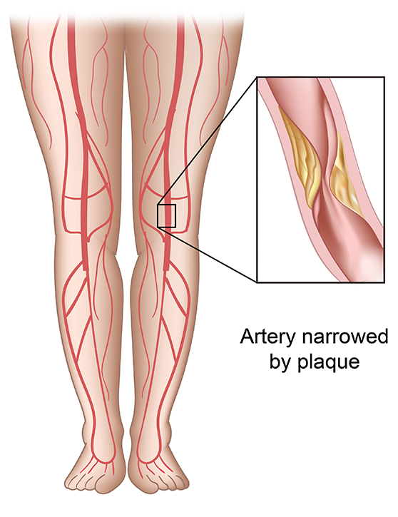 Artery disease peripheral