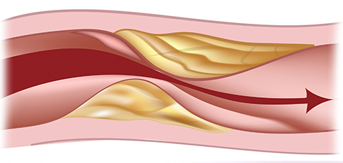 Peripheral Arterial Disease (PAD)