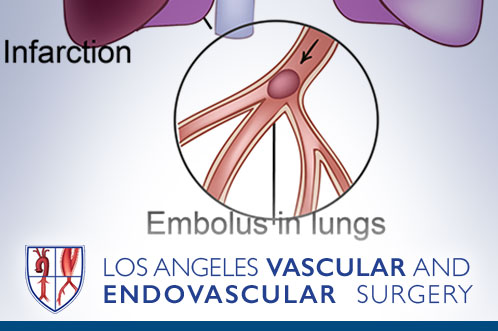 Pulmonary Embolism (PE)