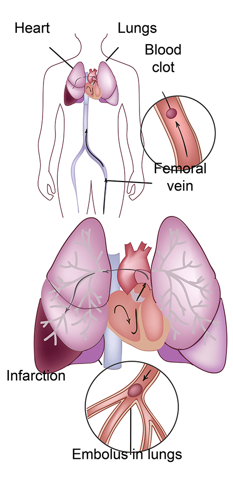 Pulmonary Embolism