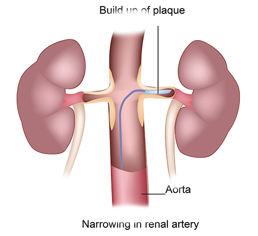 Renovascular Conditions
