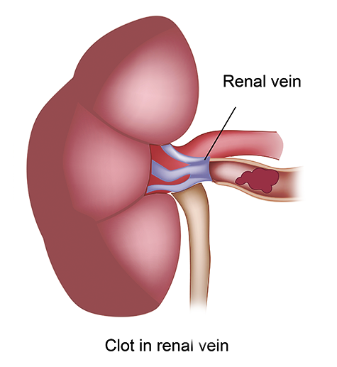 Renovascular Conditions