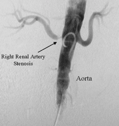 Renovascular Conditions