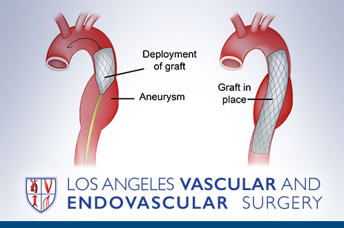 Thoracic Aortic Aneurysm