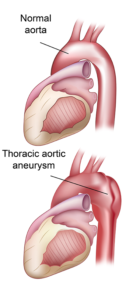 thoracic aortic aneurysm