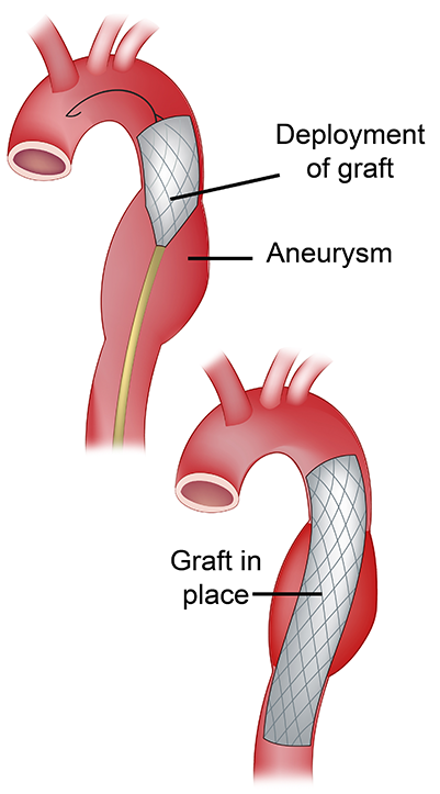 thoracic aortic aneurysm