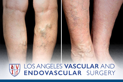 Varicose Veins