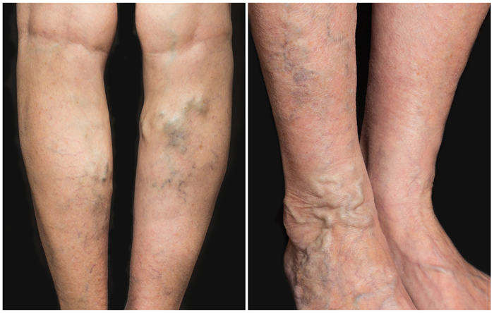 varicose veins