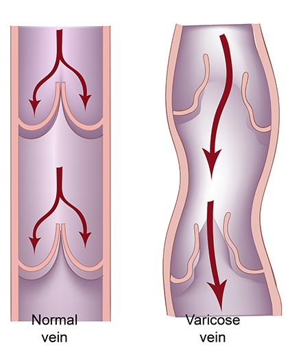 varicose veins