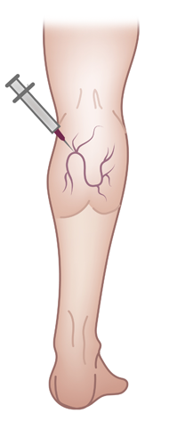 Varicose Veins