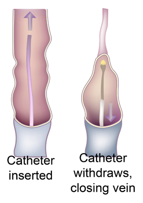 varicose veins