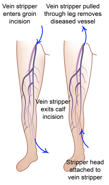 varicose veins